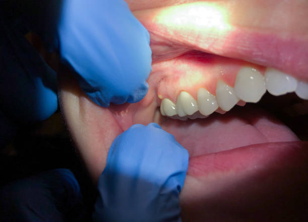 Best Emergency Dentist for Lost Fillings or Crowns in Airmont, NY